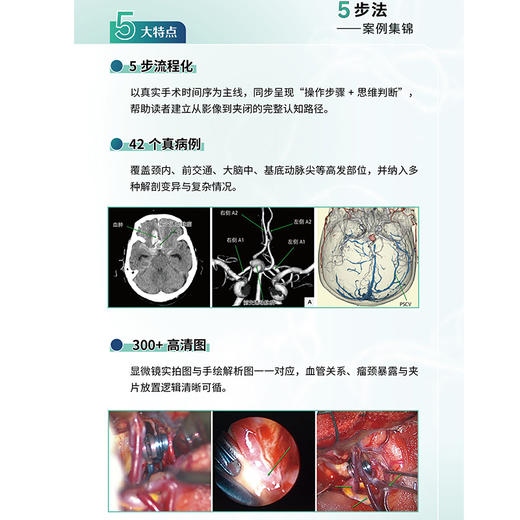 脑动脉瘤夹闭5步法 案例集锦 西徹 佟献增 王凯文 适合初中级神经外科医师脑科疾病诊断治疗教程手术技巧书 辽宁科学技术出版社 商品图4
