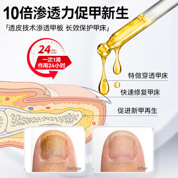 纯春堂云南本草灰指甲专用特殊效中草药抑菌液增厚发黄中空灰甲净护理盒 商品图6