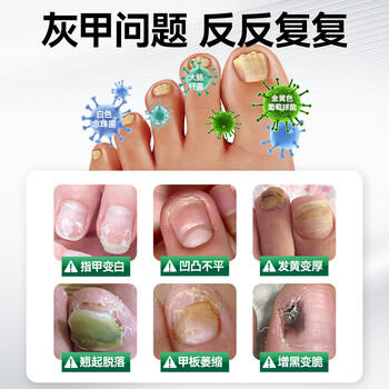 纯春堂云南本草灰指甲专用特殊效中草药抑菌液增厚发黄中空灰甲净护理盒 商品图2