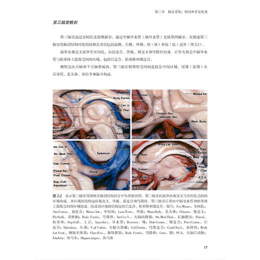脑皮质下神经外科学 王冀伟 王明栋 主译 全书涵盖脑出血、皮质下肿瘤、脑室内胶样囊肿等多种病变 神经外科 辽宁科学技术出版社 商品图4