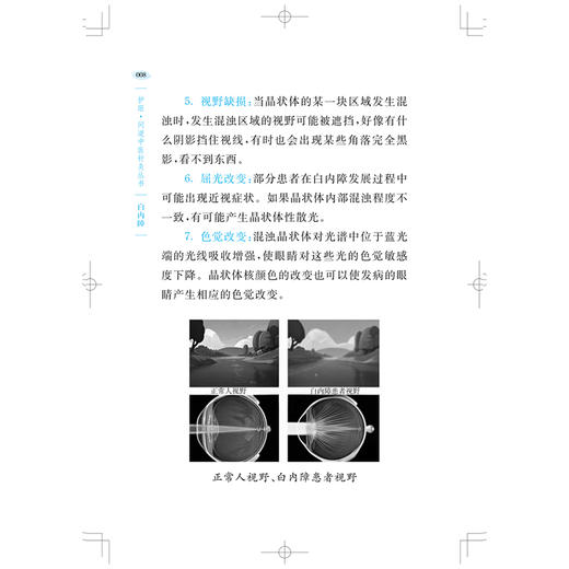 护眼·问道中医针灸丛书：白内障 胡艳美 薛金刚 主编 适合中老年白内障患者、高度近视人群及眼科医务人员参考上海科学技术出版社 商品图4