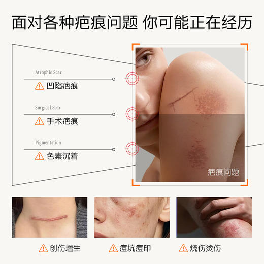 【Breathy布雷辛疤痕膏】淡黑印、修疤痕、褪红痒‼️露肤季必备 越早用效果越好 商品图1
