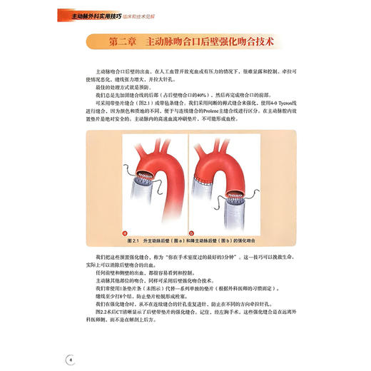 主动脉外科实用技巧——临床和技术见解 郭宏伟 钱向阳 孙晓刚 于存涛 主译 主动脉内球囊反搏 9787523534557 科学技术文献出版社 商品图4
