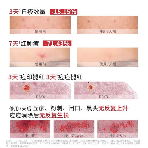 喜辽妥壬二酸祛痘精华霜15g/支 商品图2