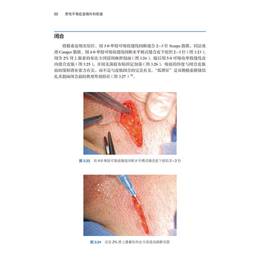 男性不育症显微外科图谱 洪锴 田龙 主译 图谱涵盖的主题和技术包括输精管切除术、输精管吻合术等 男性不育 北京大学医学出版社 商品图4