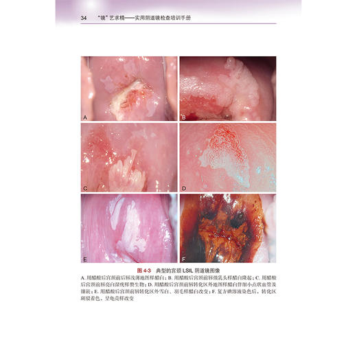 “镜”艺求精——实用阴道镜检查培训手册 魏丽惠 主编 以阴道镜检查为主线，涵盖宫颈疾病防治的各个方面 北京大学医学出版社 商品图4
