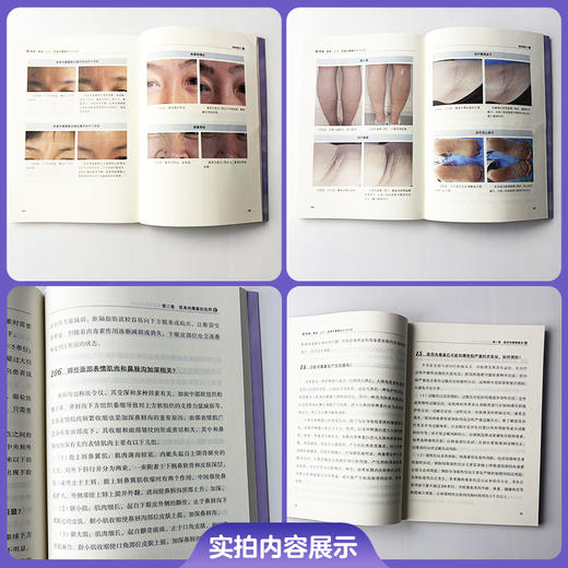 除皱 美体 止汗 医美肉毒素知识203问 胡晓根 编著 通俗解析肉毒原理 医美避坑全指南 9787567929296中国协和医科大学出版社 商品图2