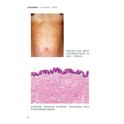皮肤病病例精粹从临床到病理 第3辑 常建民 将病理上非常精彩及典型的病例集结成册 供年轻的皮肤科医生们学习 北京大学医学出版社 商品图4