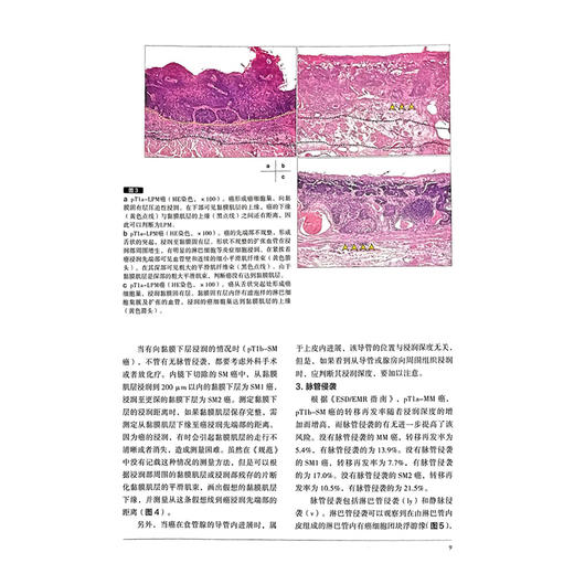 胃与肠 预后不良的早期消化道癌 日本胃与肠编委会 编著 胃与肠翻译委员会 译 肿瘤 癌 病理 9787559136978 辽宁科学技术出版社 商品图4
