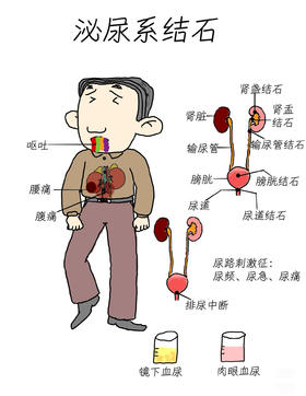尿路结石并非“成人病”，儿童也会得！这些诱因日常很常见