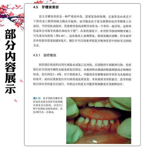 儿童牙外伤诊疗指南 王璟 李志耀 主译 口腔临床技术与方法临床病例配图讲解 儿童科学参考书籍 9787559132536辽宁科学技术出版社 商品图3