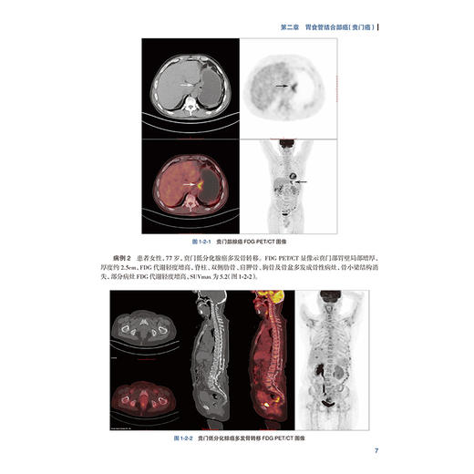 肿瘤PET CT图谱 腹盆部肿瘤卷 李思进 姚稚明 主编 内容全面实用 对于PET CT诊断医师而言 十分有指导性和参考价值 人民卫生出版社 商品图4