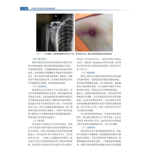 儿童骨科并发症及处理案例精析 颉强 主编  本书可用于高年资小儿骨科医师、矫形骨科医师、进修医师或研究生 科学出版社 商品图4