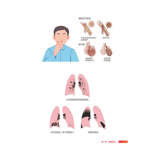 肺部疾病和/或低氧所致肺动脉高压 右心与肺血管病患者健康管理丛书 刘春丽 王岚 王健 提供全面 系统 科学的指导 人民卫生出版社 商品图4