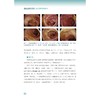 胃肠道淋巴瘤内镜实录：精选病例解析/消化内镜精析系列:疾病实例与临床解读/主编 顾于蓓 李玥 梁洁 沈骏 田丰 曹晓沧 商品缩略图4