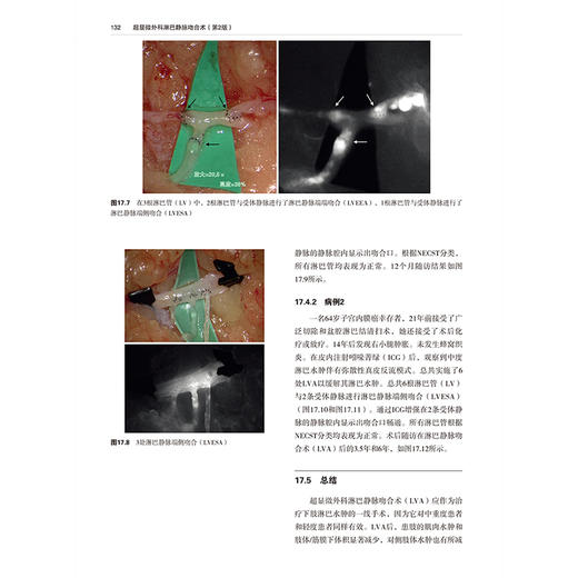 超显微外科淋巴静脉吻合术 第2二版 崔明哲 朱好辉 刘震杰 主译 系统梳理了超显微LVA技术的核心理论与操作精髓辽宁科学技术出版社 商品图4