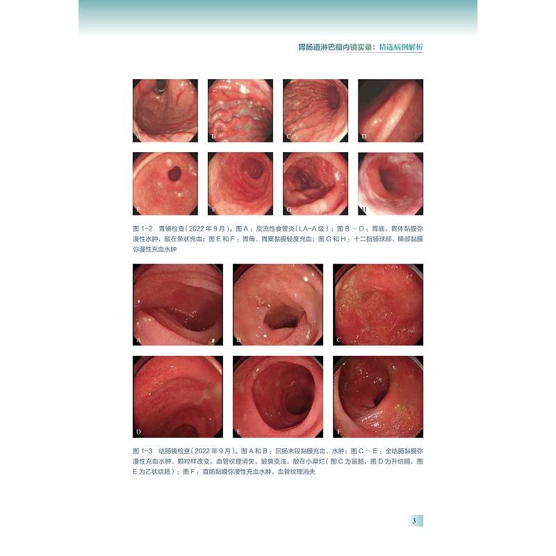 试读PDF-9787308275460(1-1)-胃肠道淋巴瘤内镜实录:精选病例解析_013.jpg