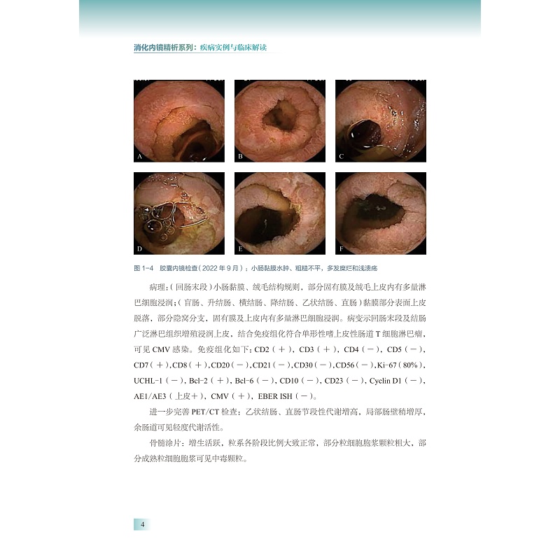 试读PDF-9787308275460(1-1)-胃肠道淋巴瘤内镜实录:精选病例解析_014.jpg