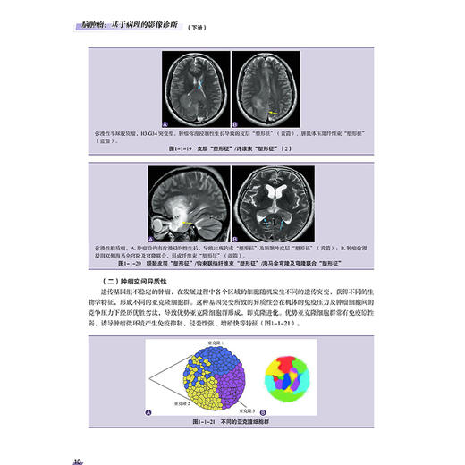 脑肿瘤 基于病理的影像诊断 下册 李建业 等主编 医学影像联盟经典丛书 深入阐释了影像学表现的组织病理学基础科学技术文献出版社 商品图3