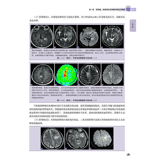 脑肿瘤 基于病理的影像诊断 下册 李建业 等主编 医学影像联盟经典丛书 深入阐释了影像学表现的组织病理学基础科学技术文献出版社 商品图4