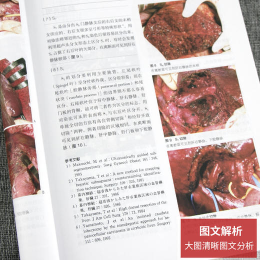 【套装3本】胰脾外科胆道外科肝脏外科要点与盲点 第2版 董家鸿主译 日常诊疗常规注意要点临床工作秘诀 人民卫生出版社 商品图4