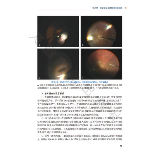 图解玻璃体视网膜手术操作要领与技巧 附手术视频 张少冲 张钊填 方冬 主编 参考书 眼科学 西医 9787117403016 人民卫生出版社 商品图4